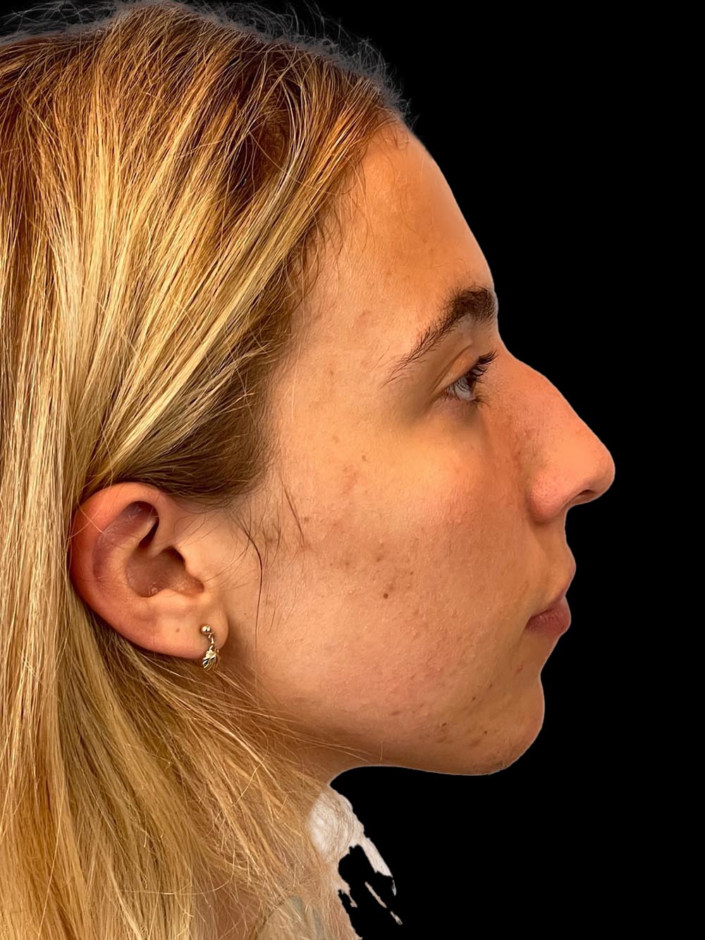 Photo of the patient’s face before the Rhinoplasty surgery. Patient 5 - Set 5