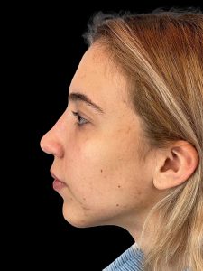 Photo of the patient’s face after the Rhinoplasty surgery. Patient 5 - Set 3