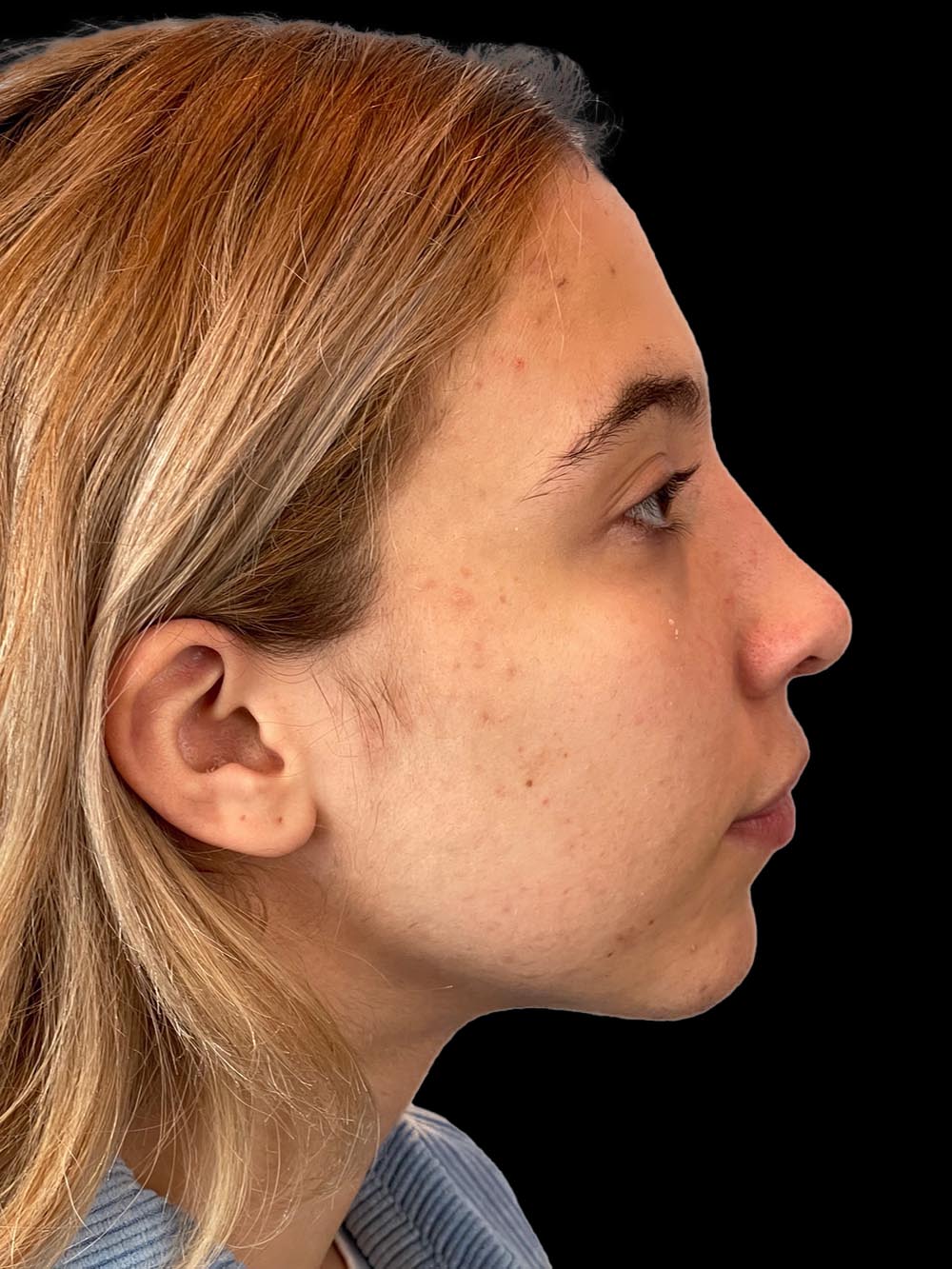 Photo of the patient’s face after the Rhinoplasty surgery. Patient 5 - Set 5