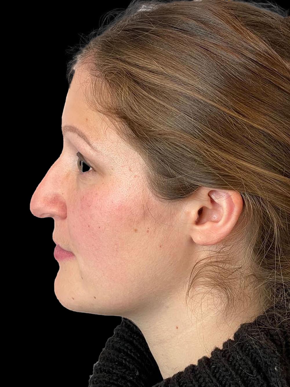 Photo of the patient’s face before the Rhinoplasty surgery. Patient 6 - Set 3