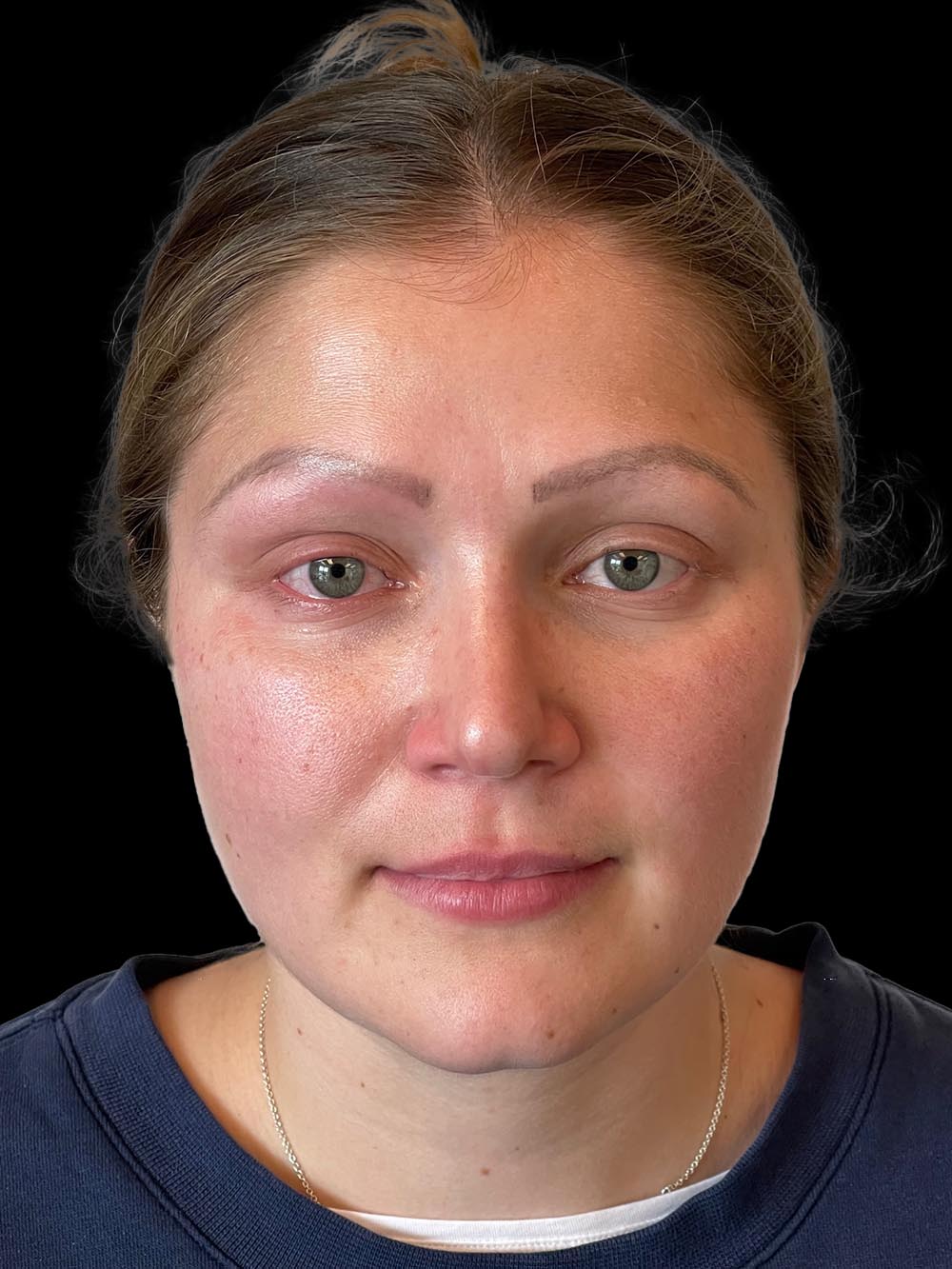 Photo of the patient’s face after the Rhinoplasty surgery. Patient 6 - Set 1