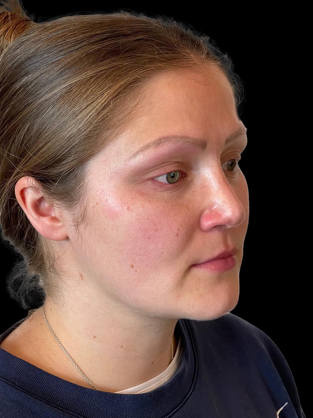 Photo of the patient’s face after the Rhinoplasty surgery. Patient 6 - Set 4