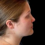 Photo of the patient’s face after the Rhinoplasty surgery. Patient 6 - Set 5