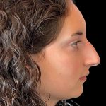 Photo of the patient’s face before the Rhinoplasty surgery. Patient 7 - Set 5