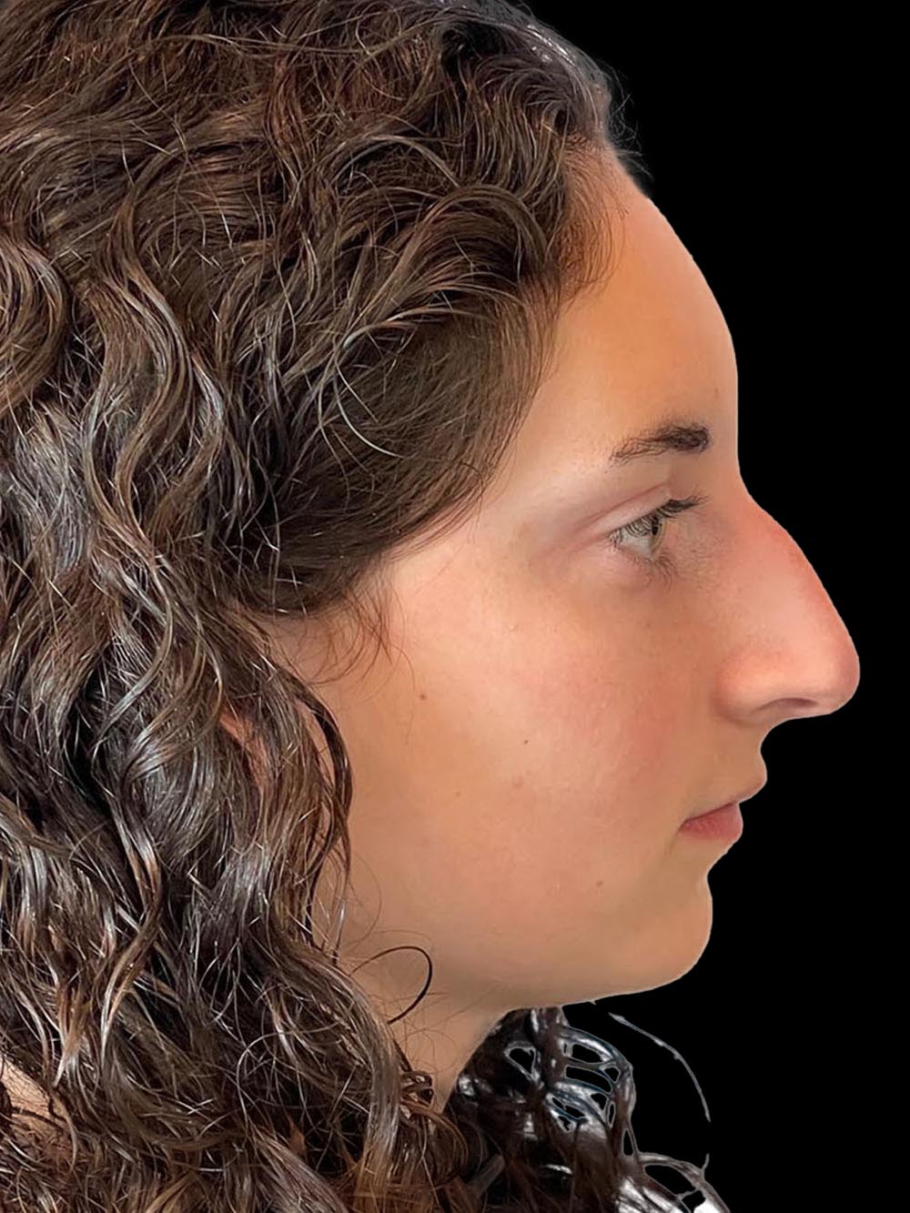 Photo of the patient’s face before the Rhinoplasty surgery. Patient 7 - Set 5