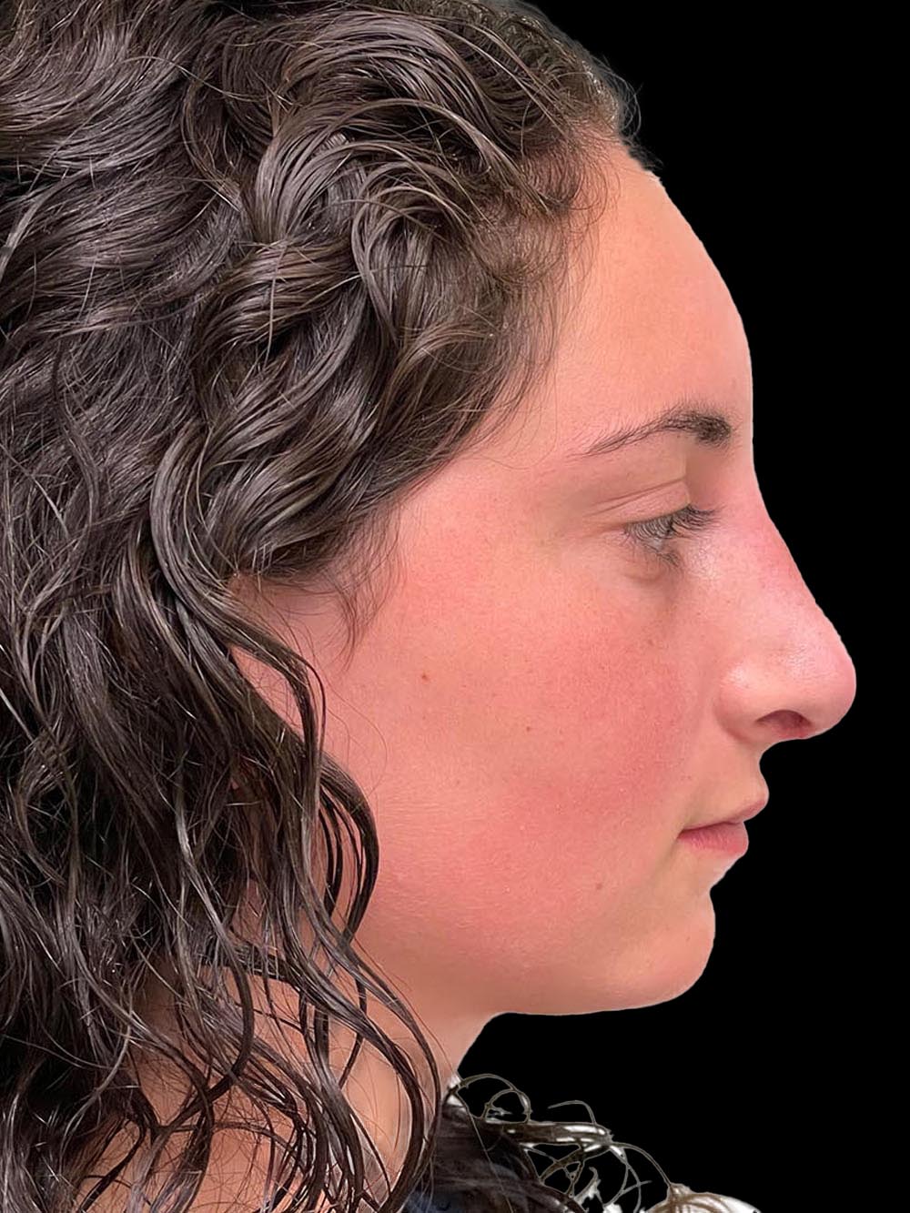 Photo of the patient’s face after the Rhinoplasty surgery. Patient 7 - Set 5