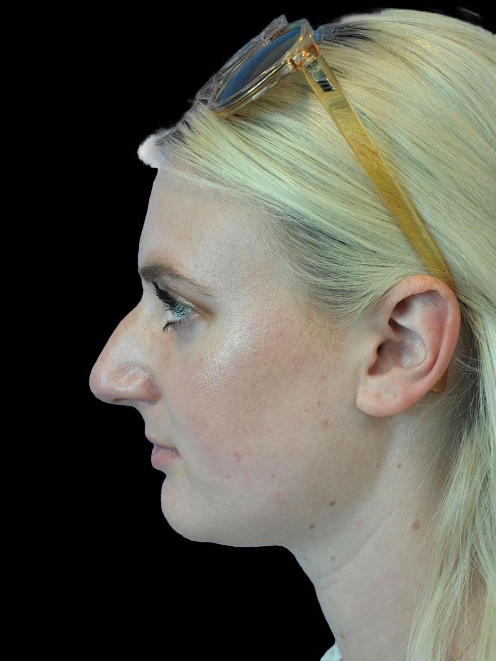 Photo of the patient’s face before the Rhinoplasty surgery. Patient 8 - Set 3