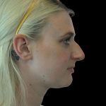 Photo of the patient’s face before the Rhinoplasty surgery. Patient 8 - Set 5