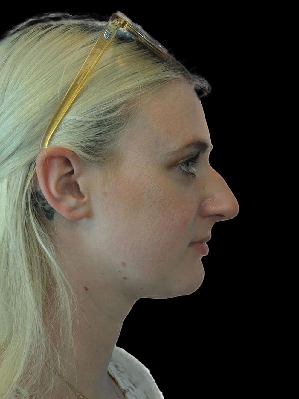 Photo of the patient’s face before the Rhinoplasty surgery. Patient 8 - Set 5