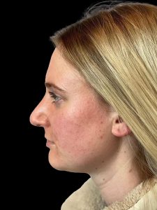 Photo of the patient’s face after the Rhinoplasty surgery. Patient 8 - Set 3