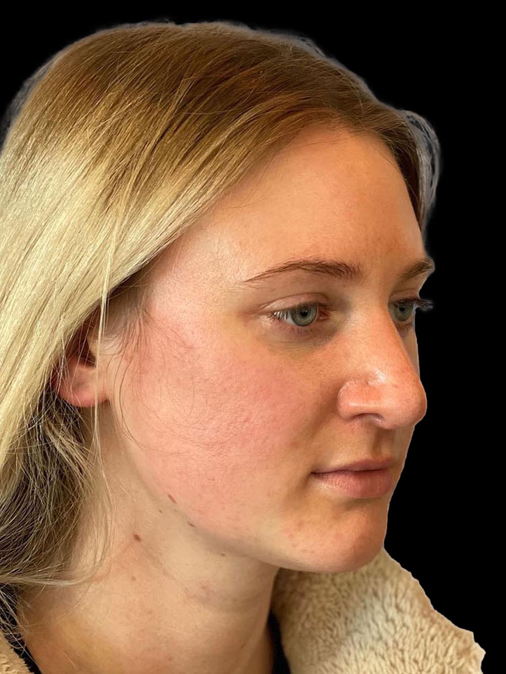 Photo of the patient’s face after the Rhinoplasty surgery. Patient 8 - Set 4