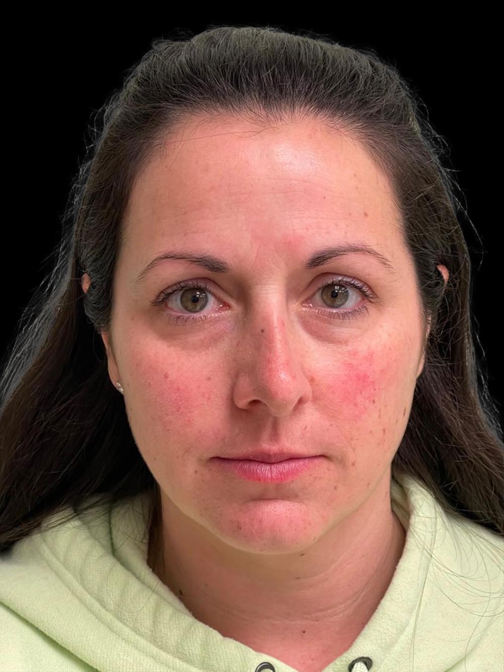 Photo of the patient’s face before the Rhinoplasty surgery. Patient 10 - Set 1