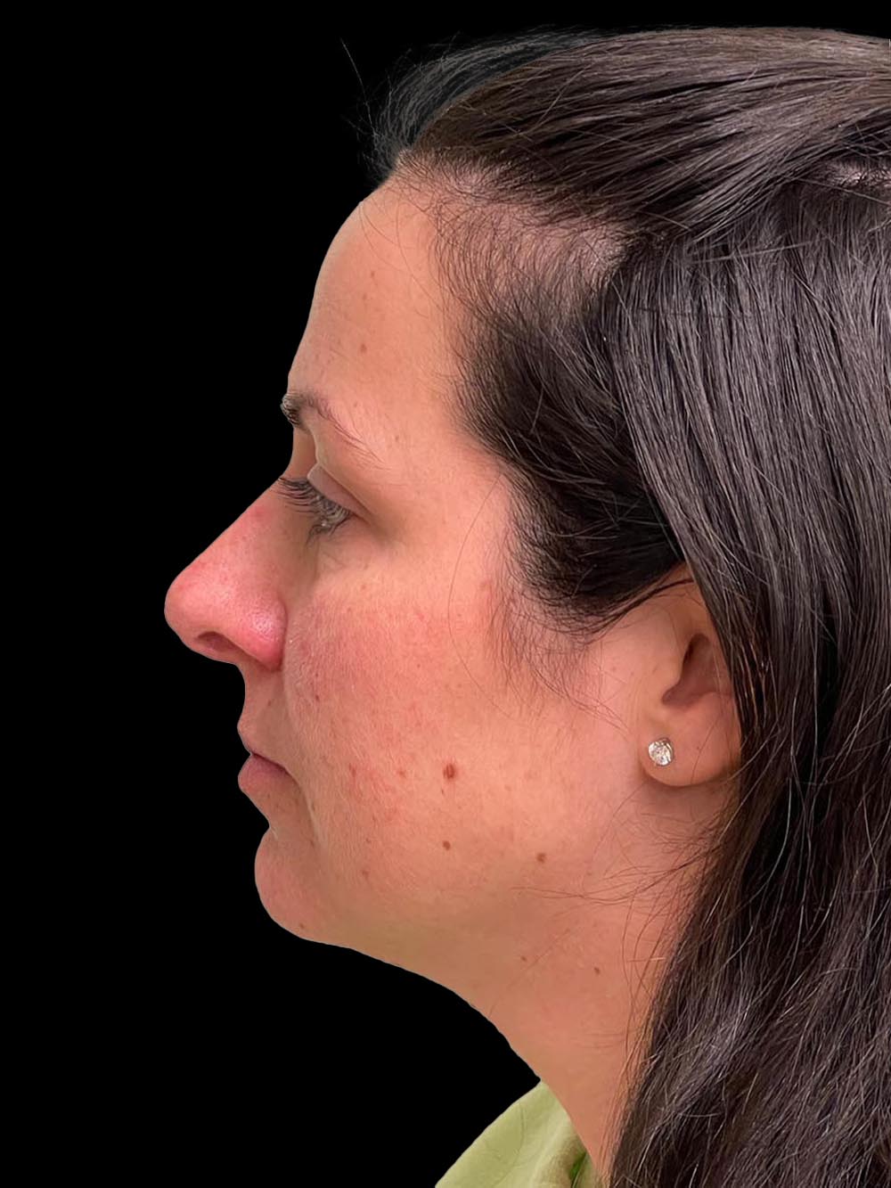 Photo of the patient’s face before the Rhinoplasty surgery. Patient 10 - Set 3