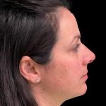 Photo of the patient’s face before the Rhinoplasty surgery. Patient 10 - Set 5
