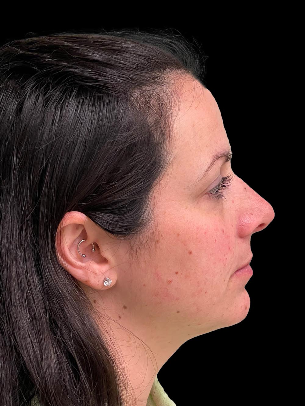 Photo of the patient’s face before the Rhinoplasty surgery. Patient 10 - Set 5