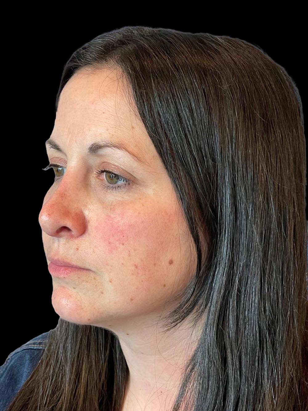 Photo of the patient’s face after the Rhinoplasty surgery. Patient 10 - Set 2