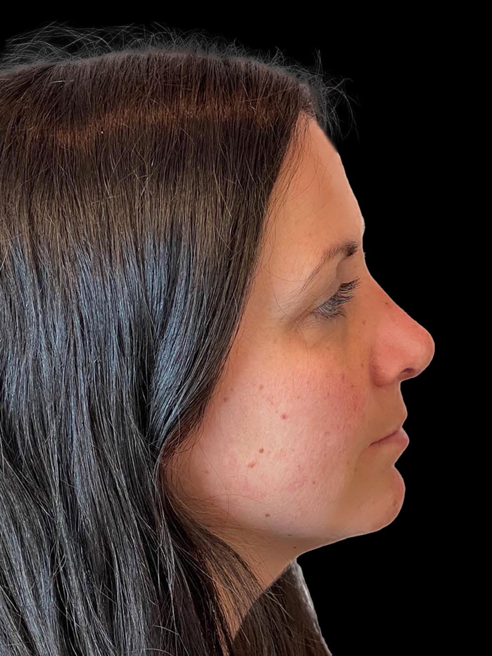 Photo of the patient’s face after the Rhinoplasty surgery. Patient 10 - Set 5