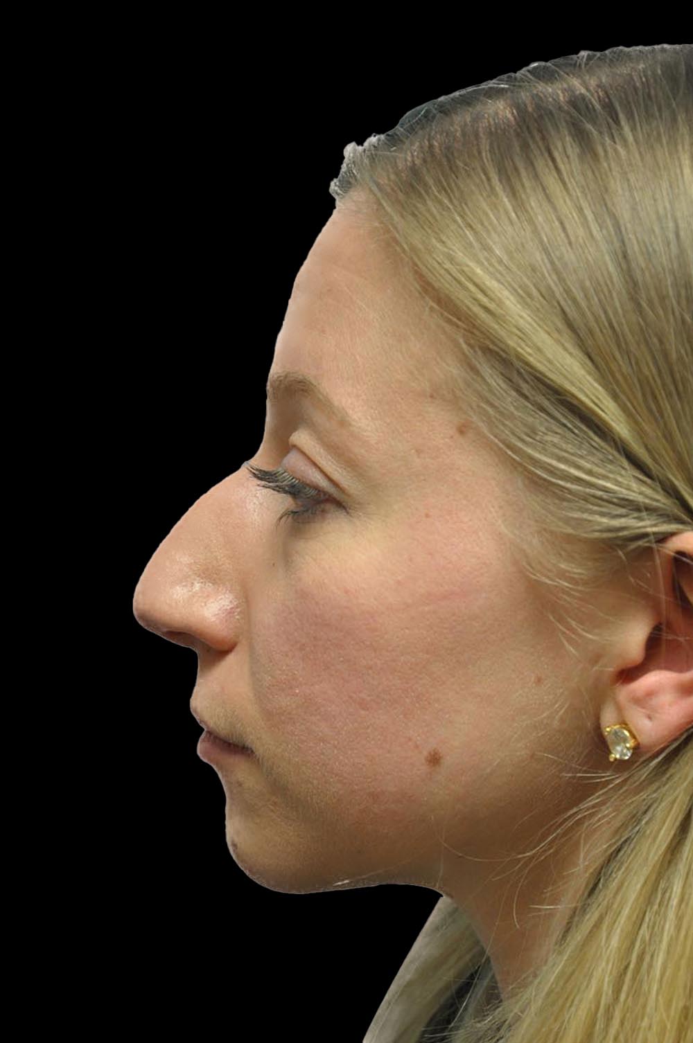 Photo of the patient’s face before the Rhinoplasty surgery. Patient 11 - Set 3