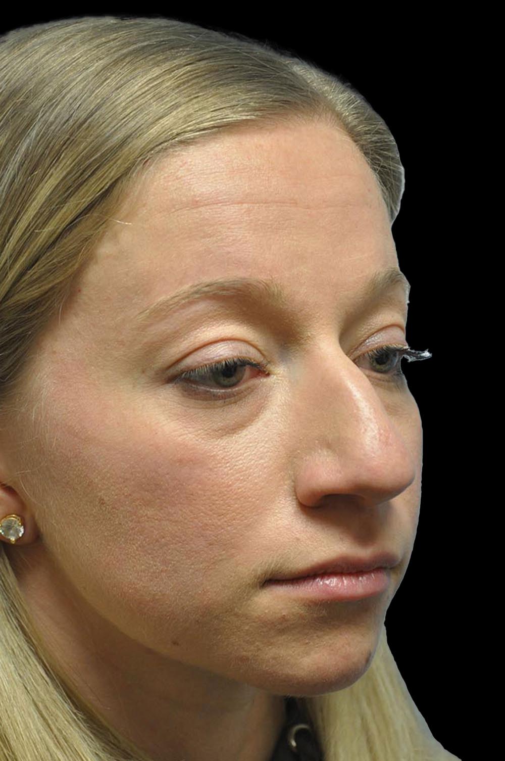 Photo of the patient’s face before the Rhinoplasty surgery. Patient 11 - Set 4