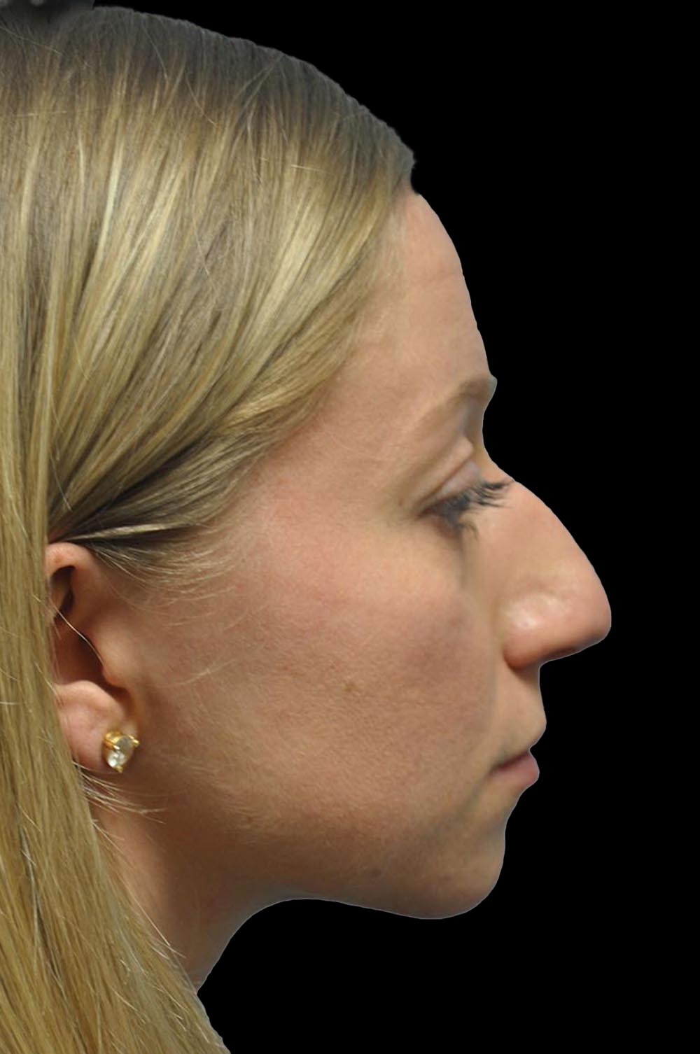 Photo of the patient’s face before the Rhinoplasty surgery. Patient 11 - Set 5