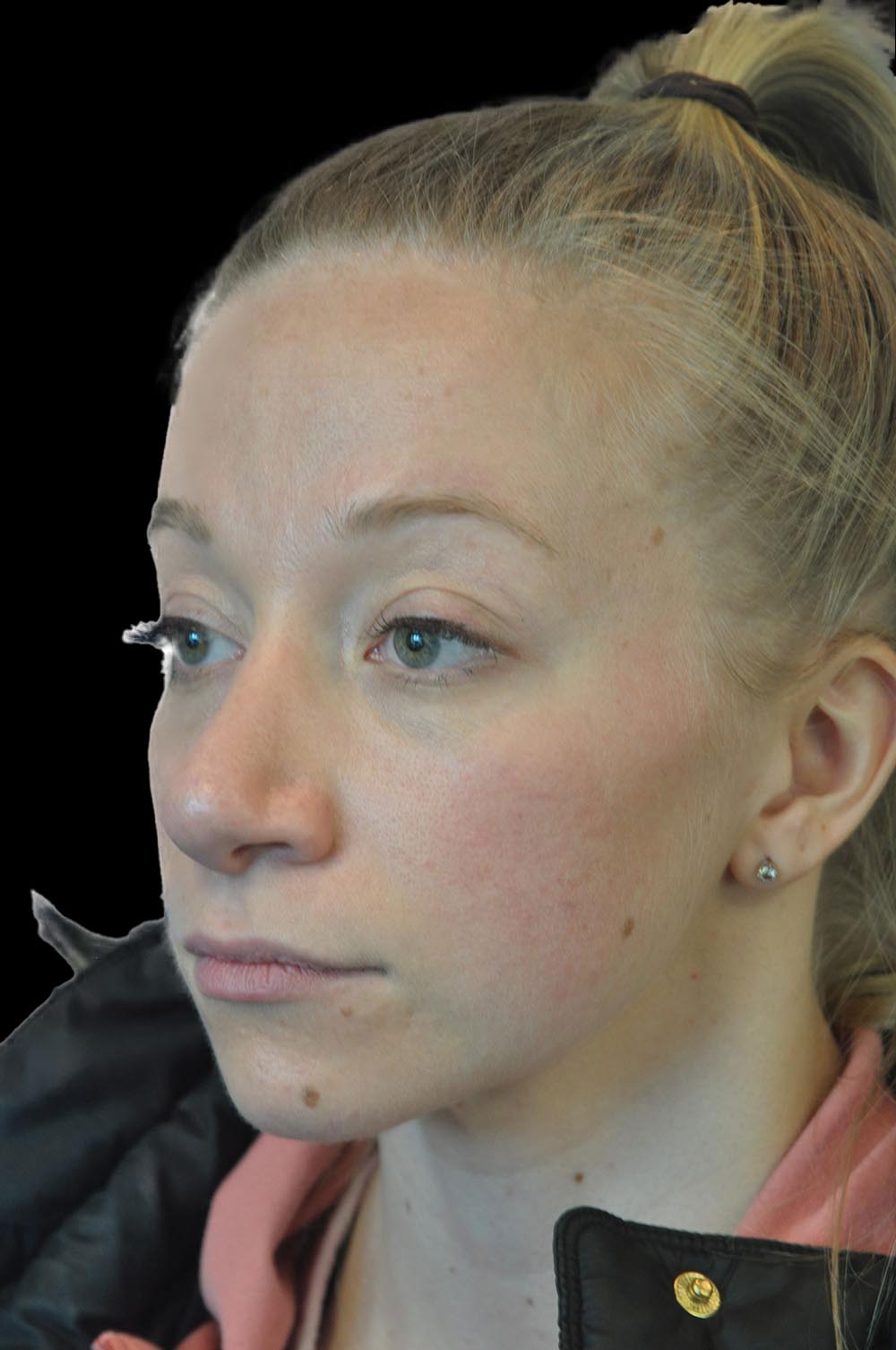 Photo of the patient’s face after the Rhinoplasty surgery. Patient 11 - Set 2