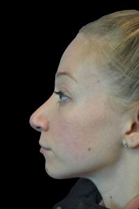 Photo of the patient’s face after the Rhinoplasty surgery. Patient 11 - Set 3