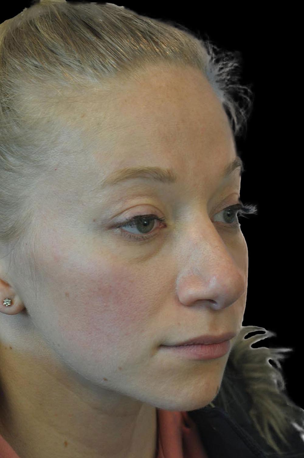Photo of the patient’s face after the Rhinoplasty surgery. Patient 11 - Set 4
