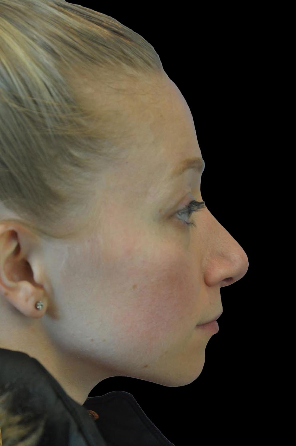 Photo of the patient’s face after the Rhinoplasty surgery. Patient 11 - Set 5