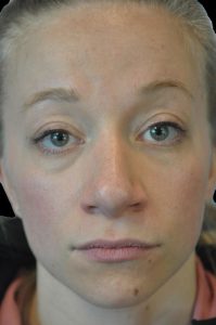 Photo of the patient’s face after the Rhinoplasty surgery. Patient 11 - Set 1