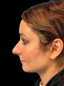Photo of the patient’s face before the Rhinoplasty surgery. Patient 12 - Set 3