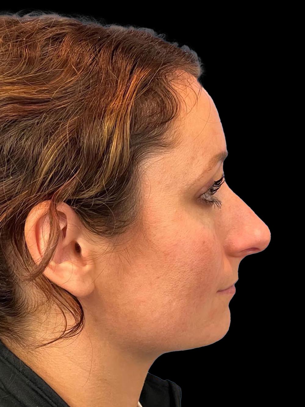 Photo of the patient’s face before the Rhinoplasty surgery. Patient 12 - Set 5