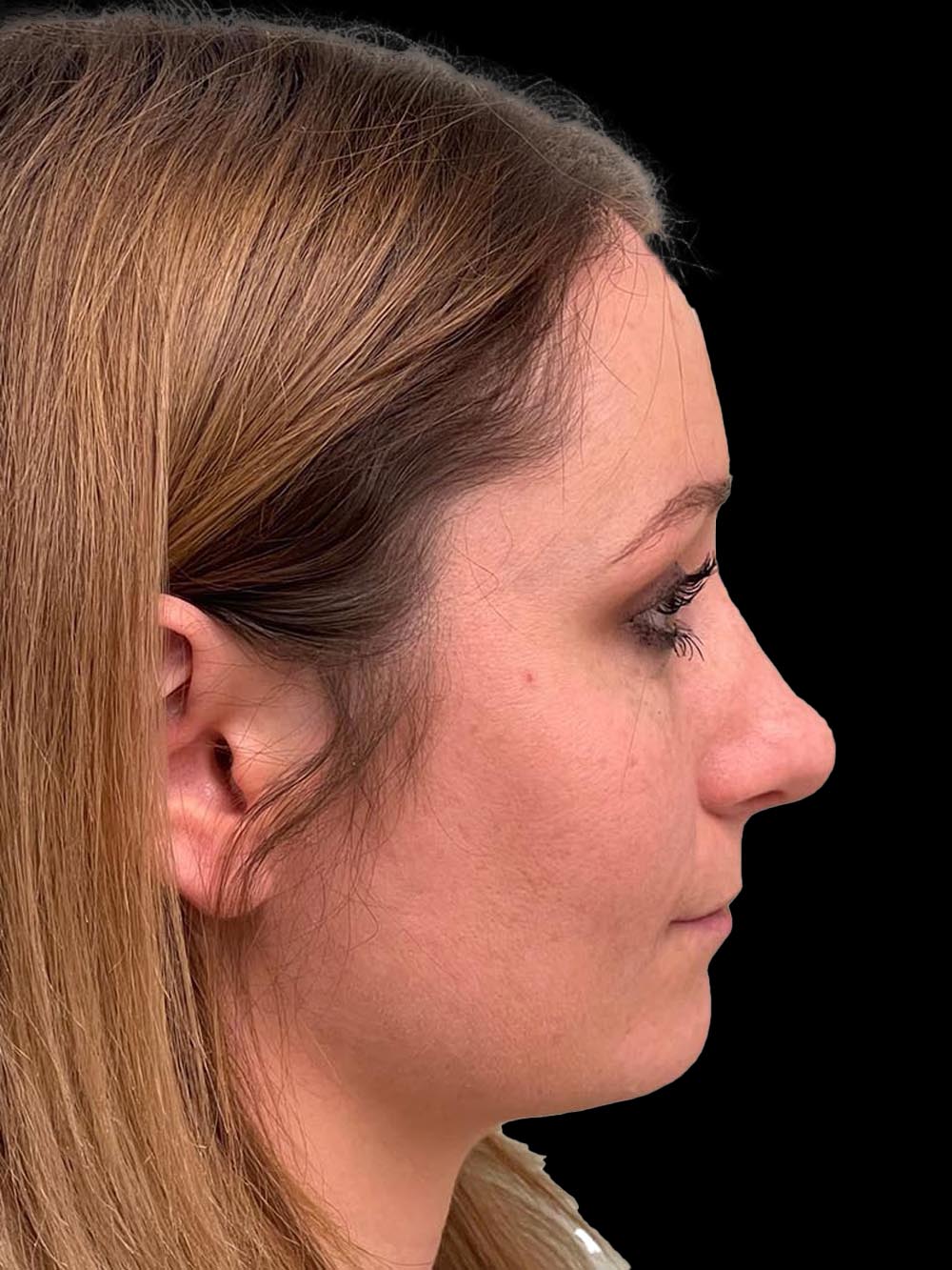 Photo of the patient’s face after the Rhinoplasty surgery. Patient 12 - Set 5