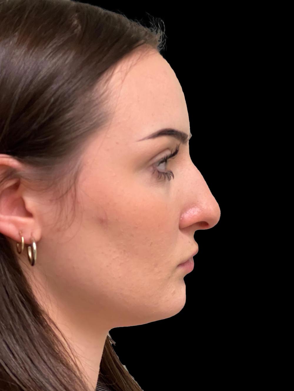 Photo of the patient’s face before the Rhinoplasty surgery. Patient 14 - Set 5