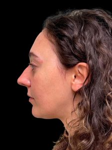 Photo of the patient’s face before the Rhinoplasty surgery. Patient 15 - Set 3