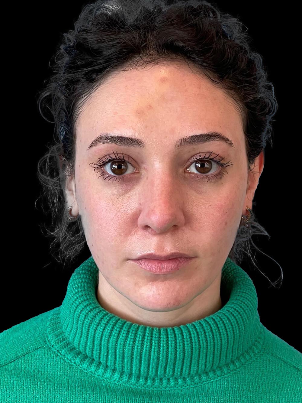 Photo of the patient’s face after the Rhinoplasty surgery. Patient 15 - Set 1