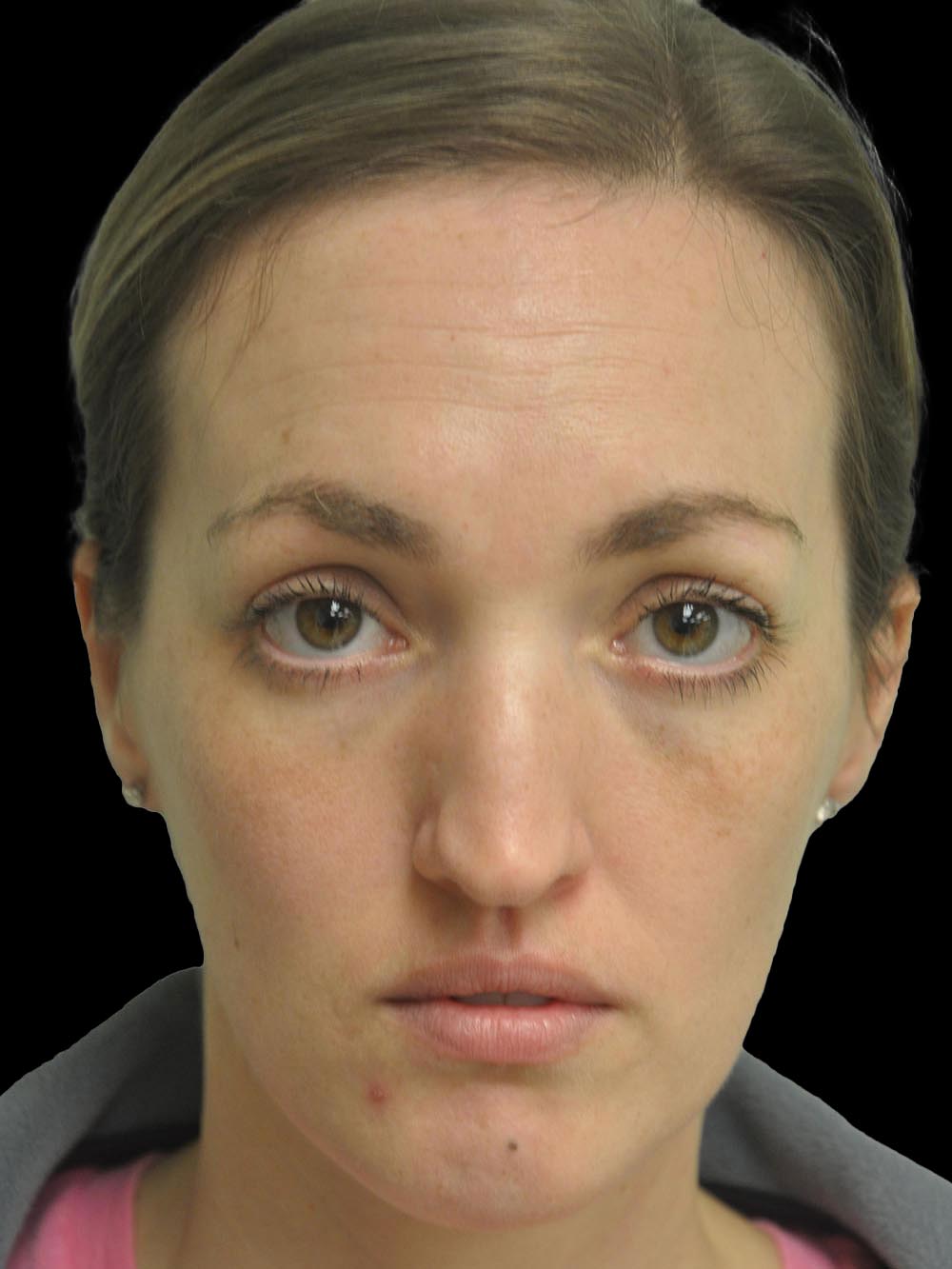 Photo of the patient’s face before the Rhinoplasty surgery. Patient 16 - Set 1