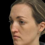 Photo of the patient’s face before the Rhinoplasty surgery. Patient 16 - Set 2