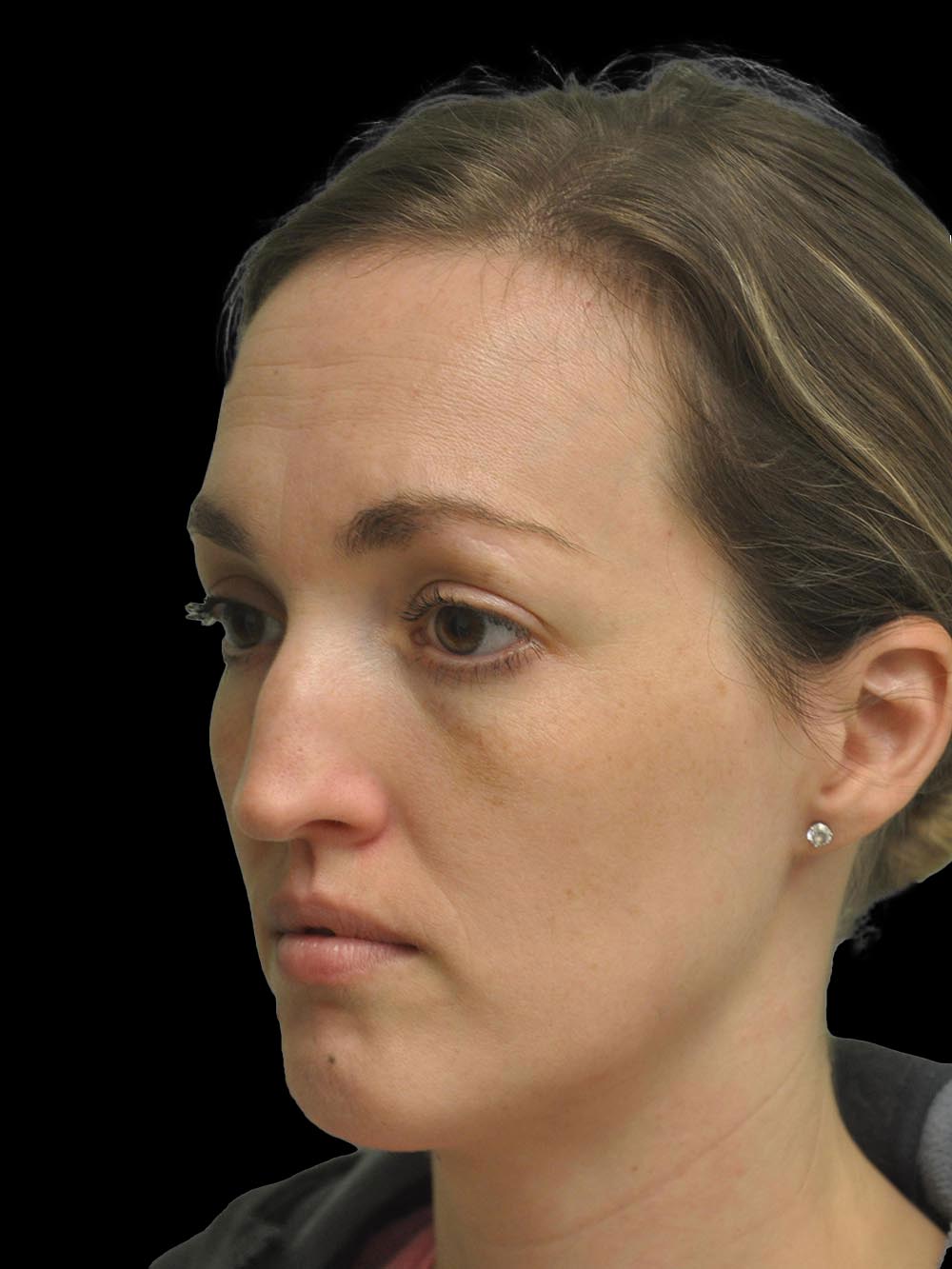 Photo of the patient’s face before the Rhinoplasty surgery. Patient 16 - Set 2