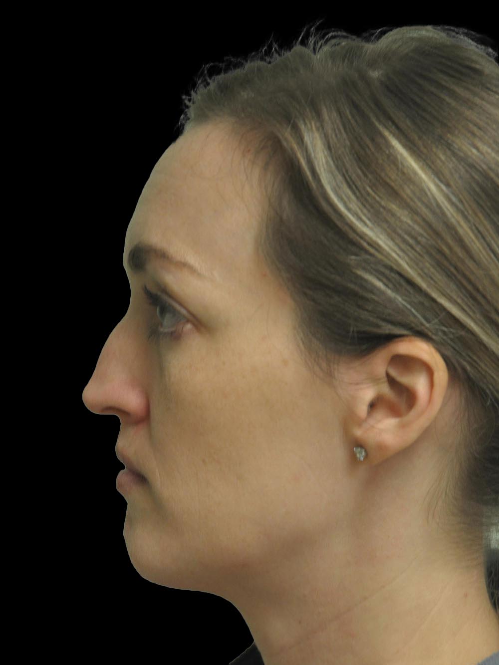 Photo of the patient’s face before the Rhinoplasty surgery. Patient 16 - Set 3