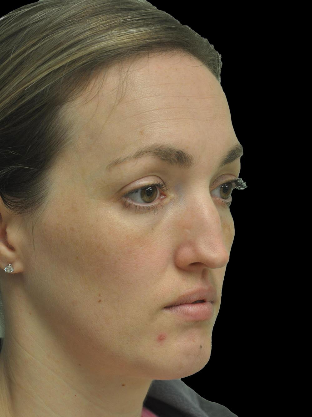 Photo of the patient’s face before the Rhinoplasty surgery. Patient 16 - Set 4