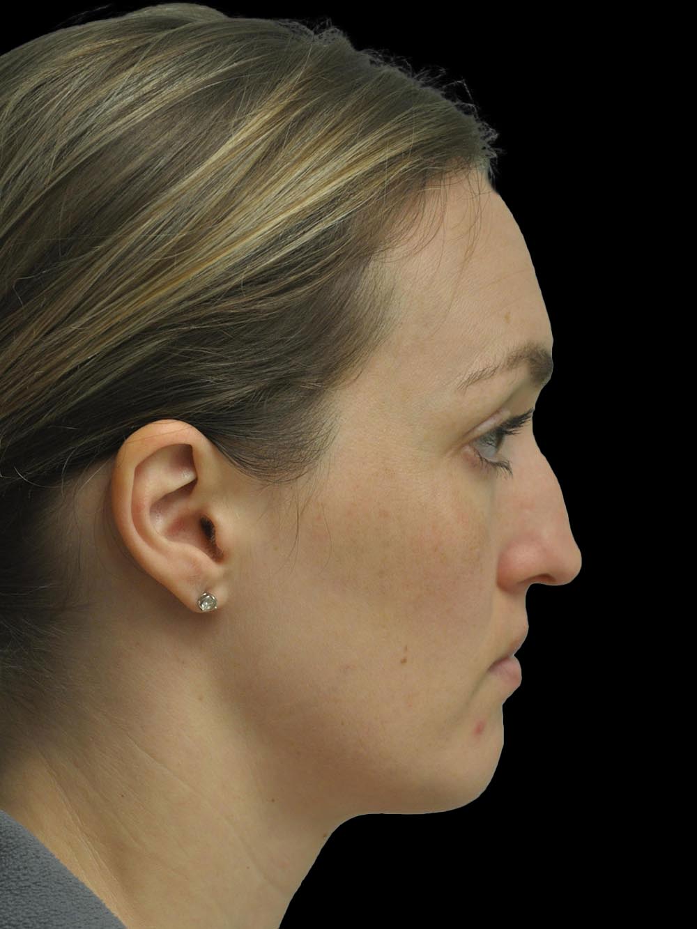 Photo of the patient’s face before the Rhinoplasty surgery. Patient 16 - Set 5