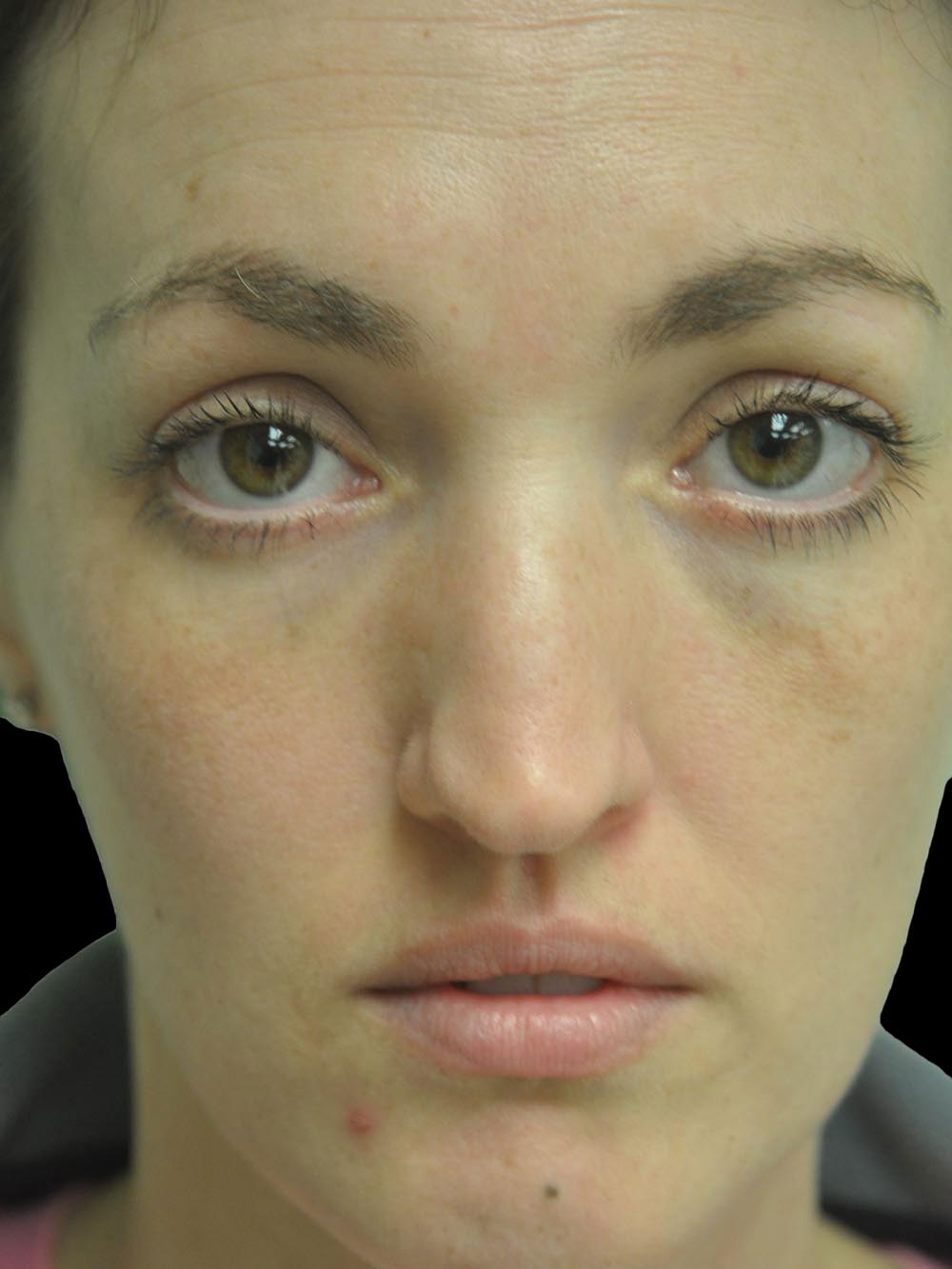 Photo of the patient’s face before the Rhinoplasty surgery. Patient 16 - Set 6