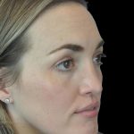 Photo of the patient’s face after the Rhinoplasty surgery. Patient 16 - Set 4