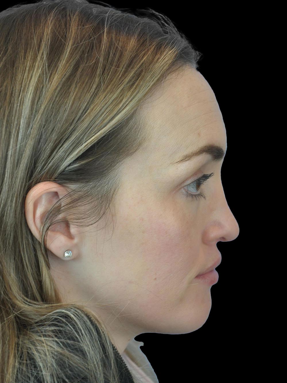 Photo of the patient’s face after the Rhinoplasty surgery. Patient 16 - Set 5
