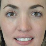 Photo of the patient’s face after the Rhinoplasty surgery. Patient 16 - Set 6