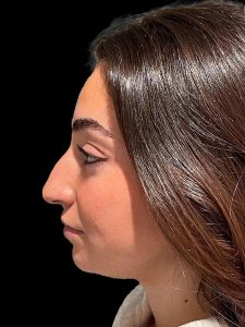 Photo of the patient’s face before the Rhinoplasty surgery. Patient 17 - Set 3