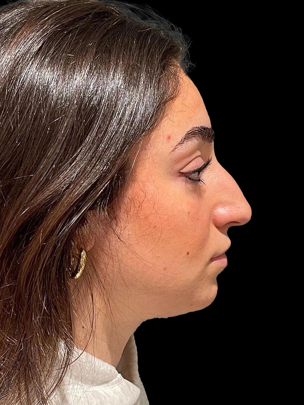 Photo of the patient’s face before the Rhinoplasty surgery. Patient 17 - Set 5