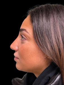 Photo of the patient’s face after the Rhinoplasty surgery. Patient 17 - Set 3