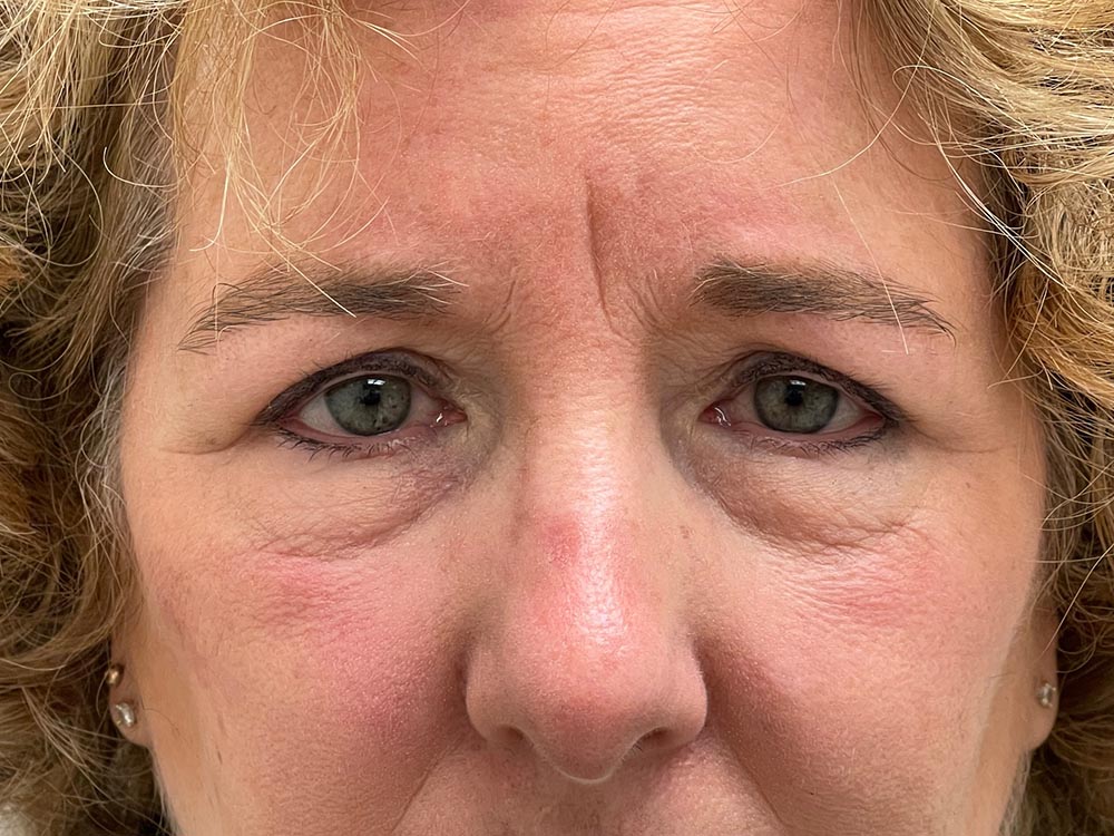 Photo of the patient’s face before the Browlift surgery. Patient 1 - Set 6