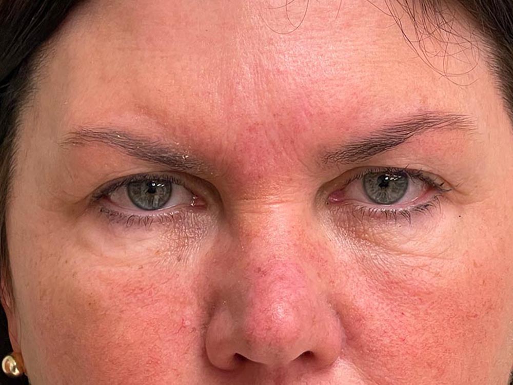 Photo of the patient’s face before the Browlift surgery. Patient 3 - Set 5